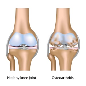 osteoarthritis, the physio co